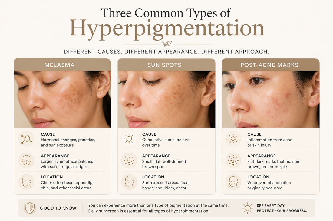 Melasma, Sun Spots, or Post-Acne Marks? How to Tell the Difference