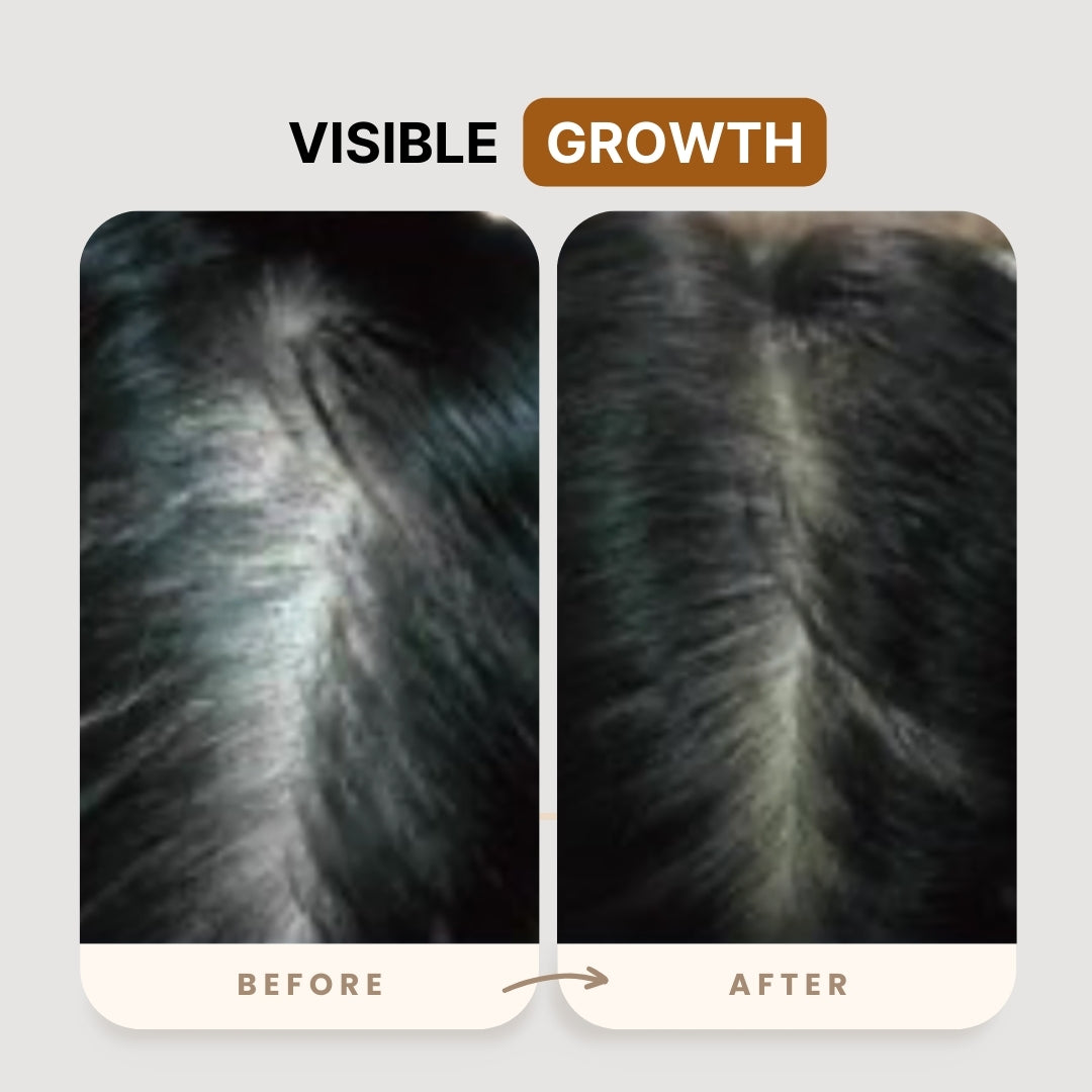 KX-826 Plant Extract Hair Regrowth Treatment