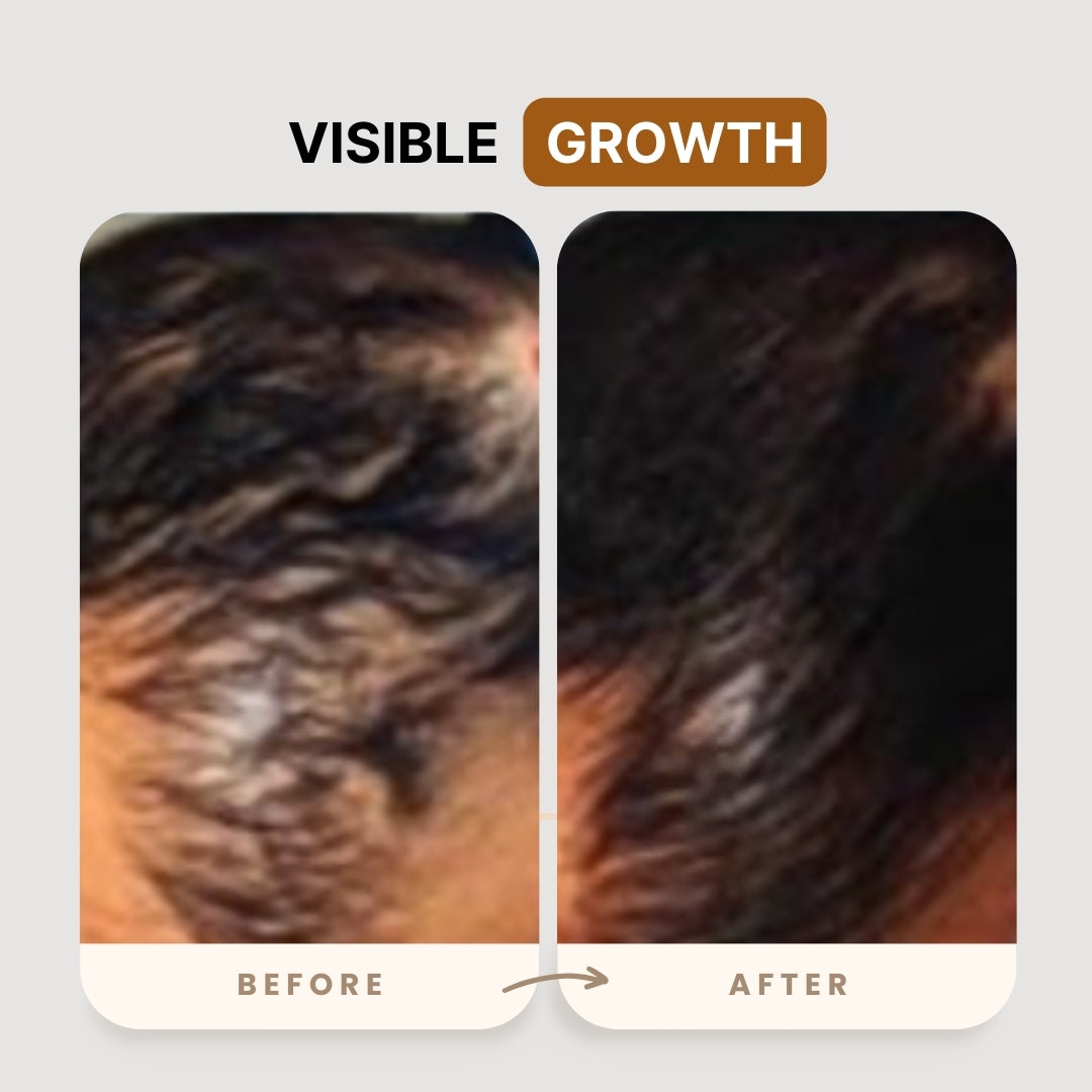 KX-826 Plant Extract Hair Regrowth Treatment
